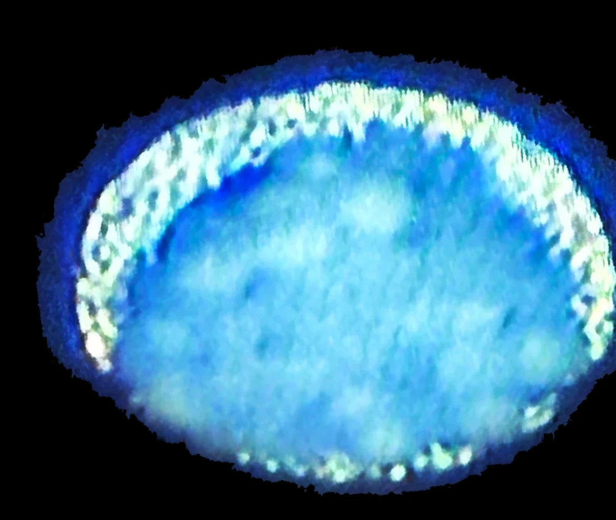 Scanning electron micrograph of an occluded needle hub